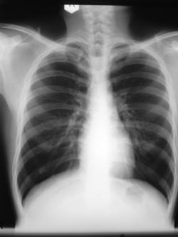 Name:  BTMH_COPD_image_generic_chest_x-ray_normal.jpg
Views: 10483
Size:  10.0 KB